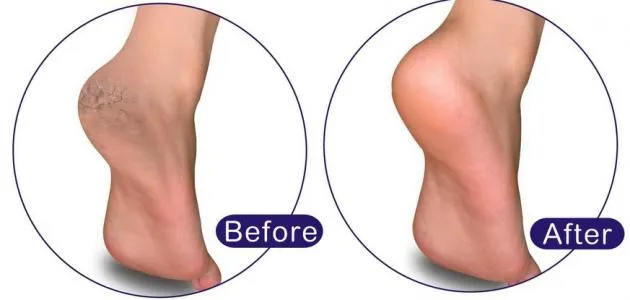 علاج جفاف وتشققات القدمين